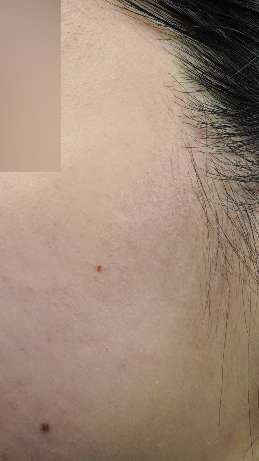 복합 여드름 치료 후 피부