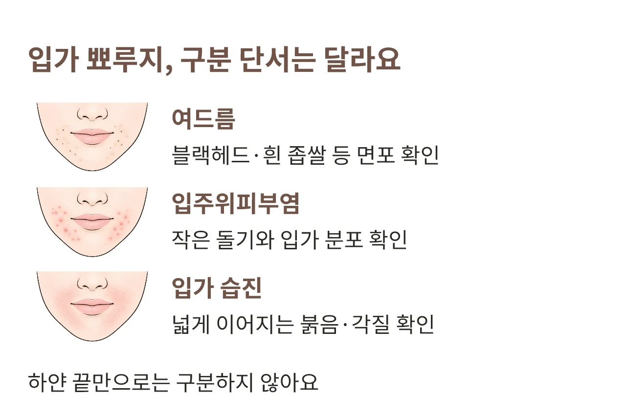 입주위피부염과 여드름, 입가 습진을 구분할 때 살펴보는 단서를 설명하는 그림