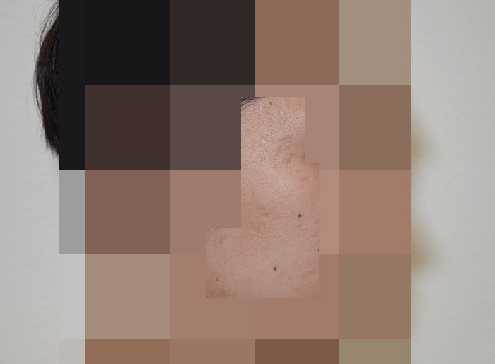 안양점 여드름흉터 치료 후 사진 · 2023.01