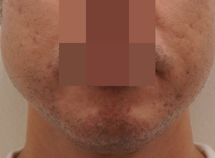 안양점 모낭염 치료 후 사진 · 2023.03