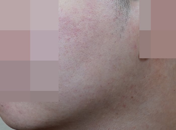 안양점 지루성피부염 치료 후 사진 · 2023.06