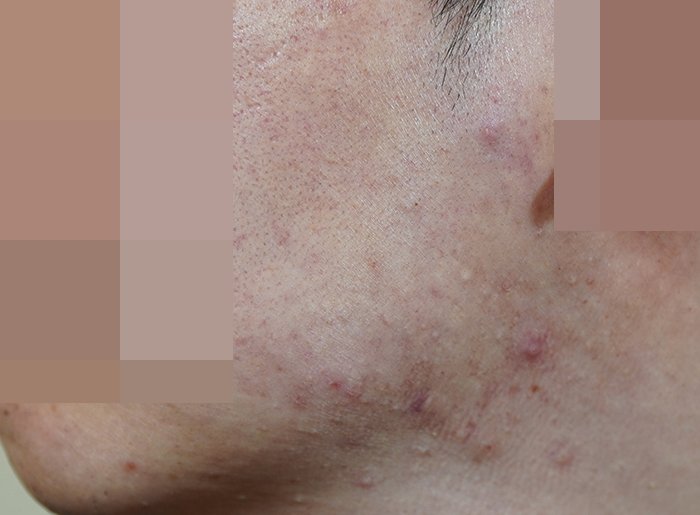 안양점 지루성피부염 치료 전 사진 · 2023.01