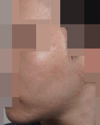 안양점 성인여드름·좁쌀여드름·지루성피부염 치료 후 사진 · 2024.05