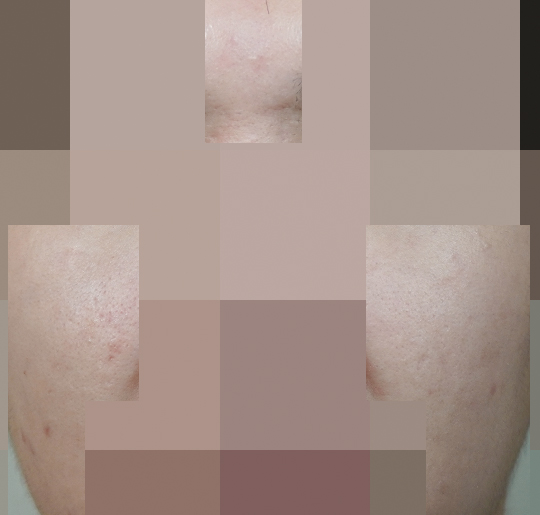 안양점 모낭염 치료 후 사진 · 2023.05