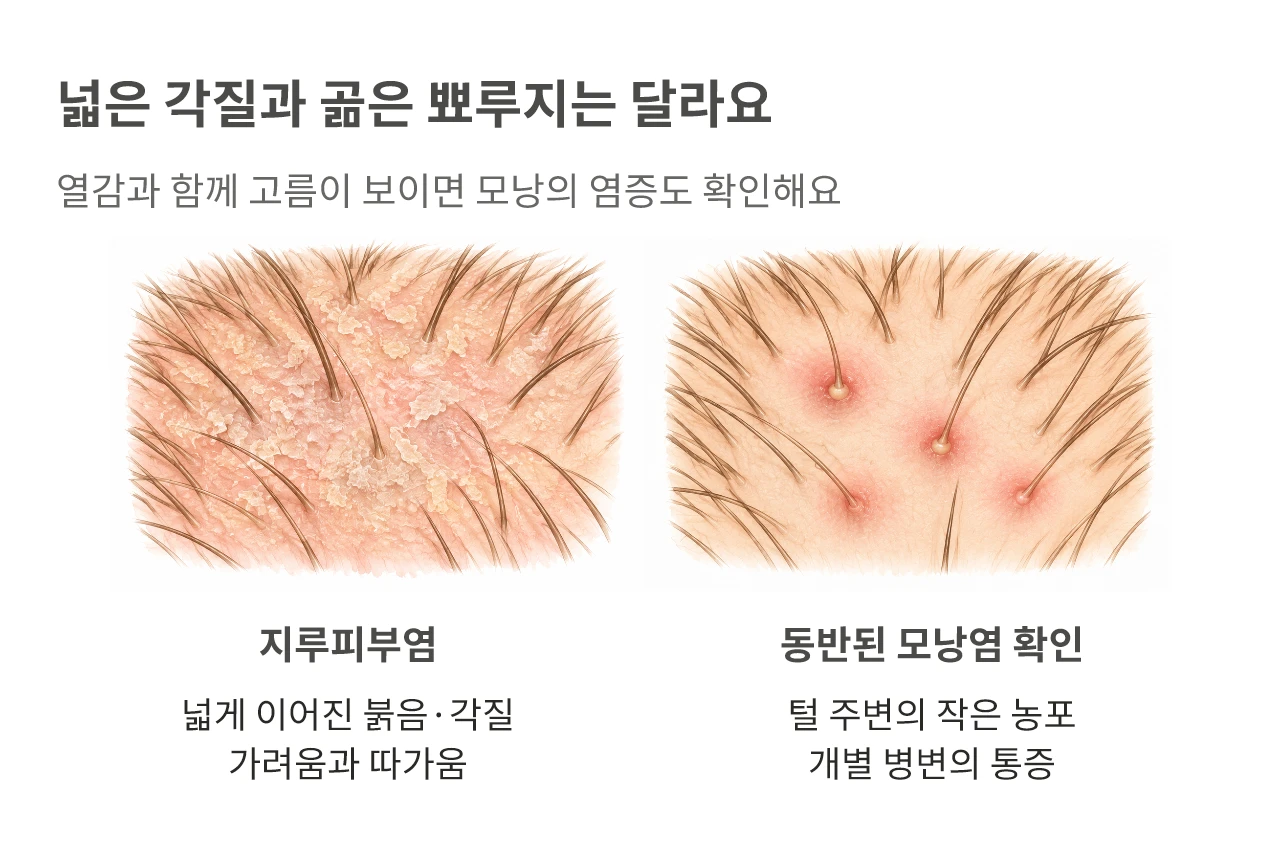 넓은 각질과 곪은 뾰루지는 달라요. 열감과 함께 고름이 보이면 모낭의 염증도 확인해요
