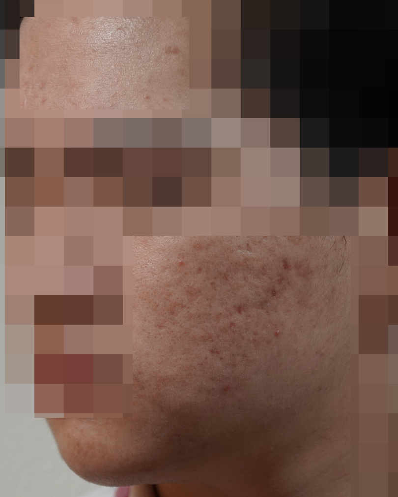 안양점 청소년여드름 치료 후 사진 · 2022.09