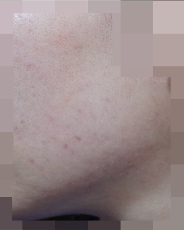 안양점 지루성피부염·성인여드름·모낭염·화농성여드름 치료 후 사진 · 2022.03