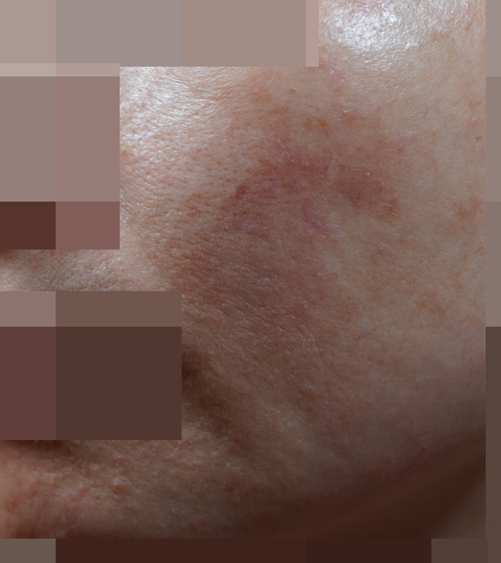 안양점 지루성피부염 치료 전 사진 · 2023.06
