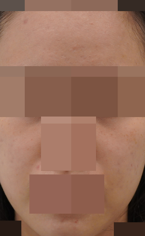 안양점 모낭염 치료 후 사진 · 2023.05