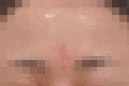 안양점 대상포진흉터 치료 후 사진 · 2023.11