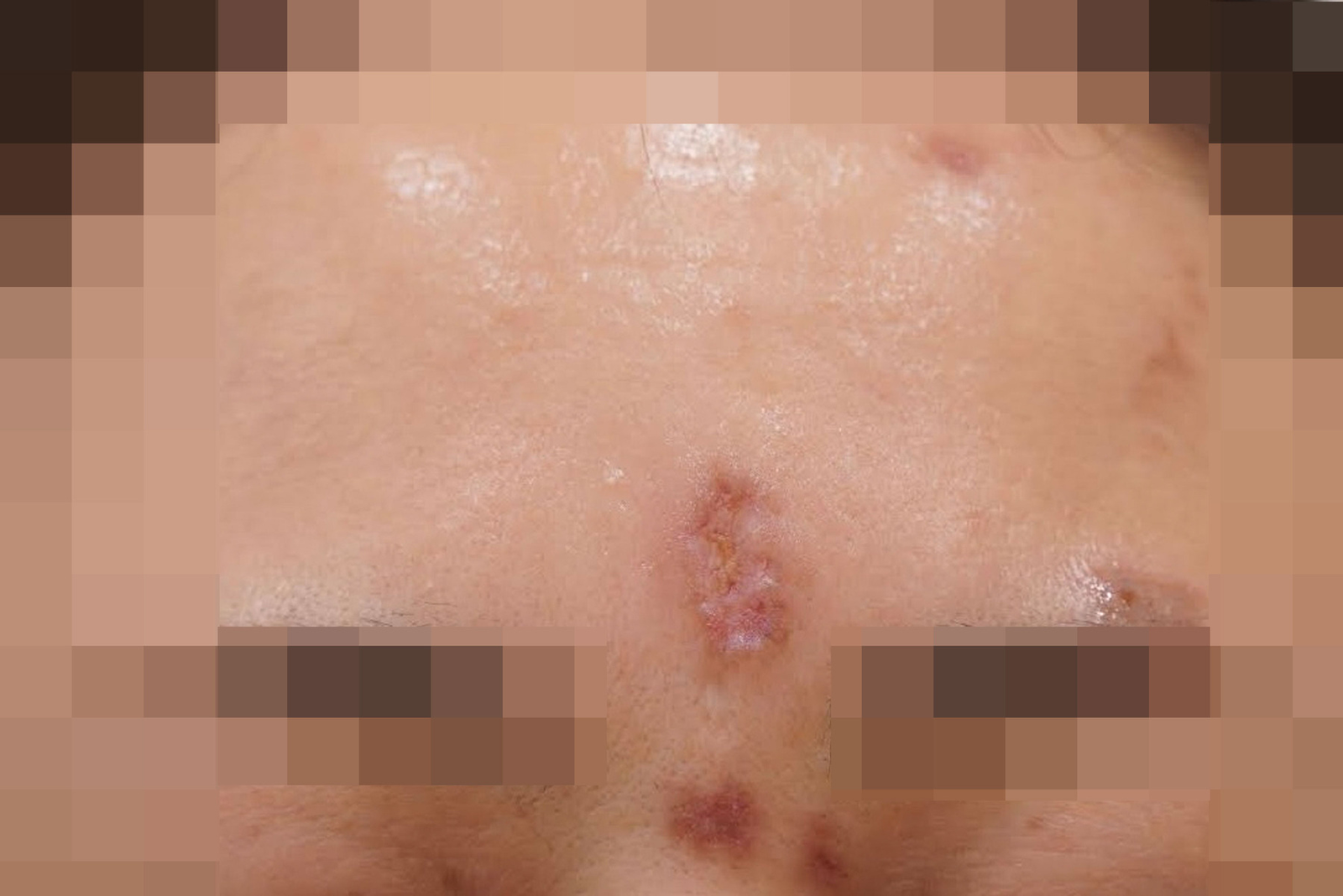 안양점 대상포진흉터 치료 전 사진 · 2023.06