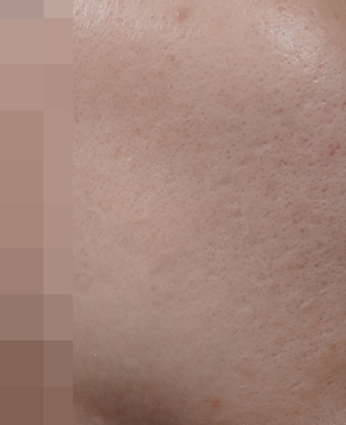 안양점 여드름흉터 치료 후 사진 · 2023.06