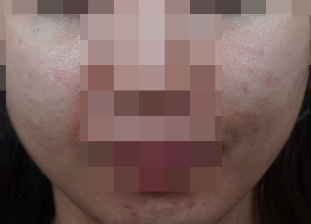 안양점 얼굴화농성여드름 치료 후 사진 · 2023.05