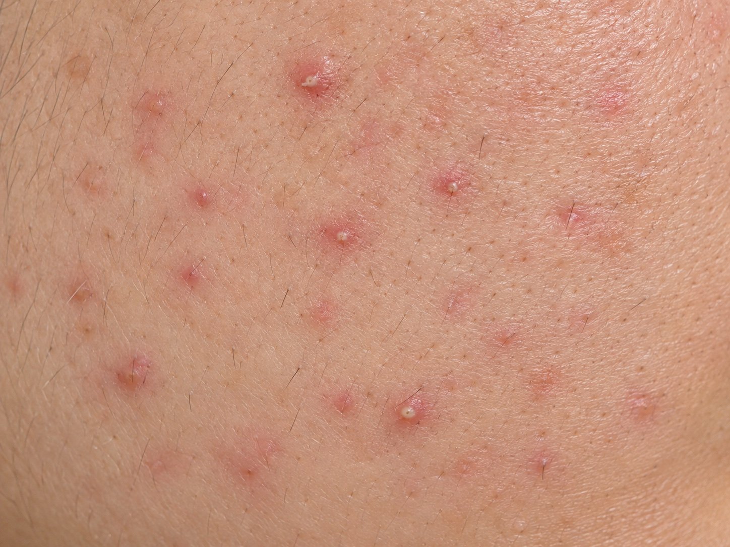 모낭 주변의 작은 붉은 돌기와 농포가 보이는 피부 예시