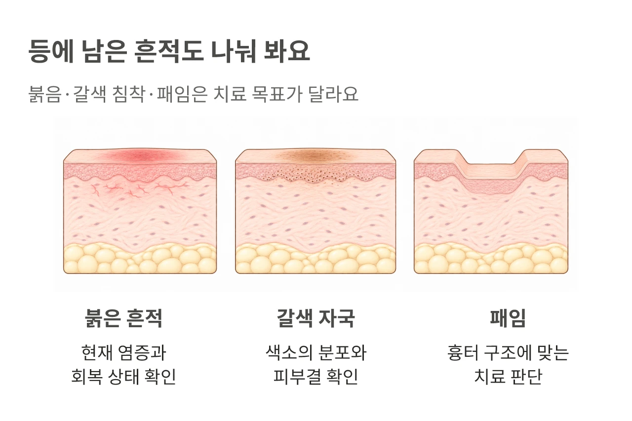 등에 남은 흔적도 나눠 봐요. 붉음·갈색 침착·패임은 치료 목표가 달라요