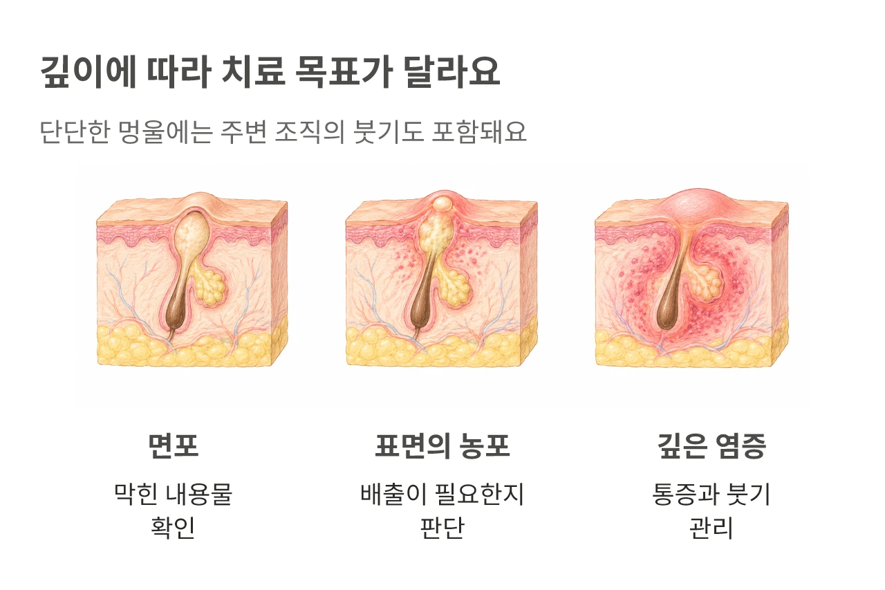깊이에 따라 치료 목표가 달라요. 단단한 멍울에는 주변 조직의 붓기도 포함돼요