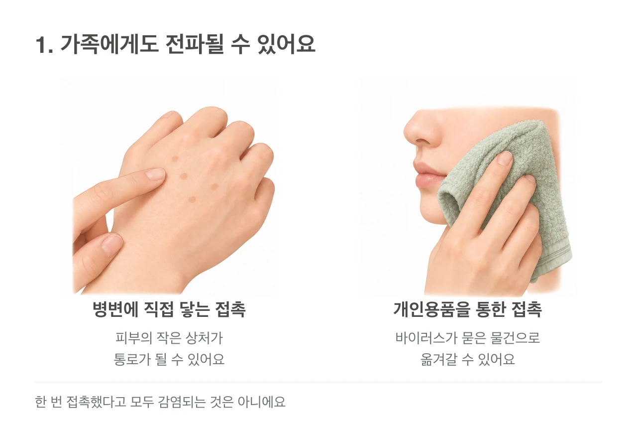 편평사마귀 병변에 손가락이 닿는 모습과 수건이 얼굴 피부에 닿는 모습을 통해 가능한 접촉 경로를 설명하는 그림.