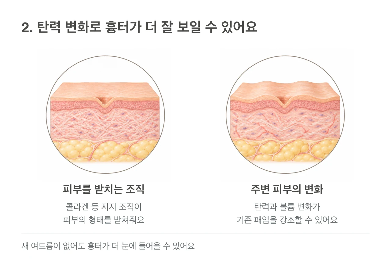 기존 패임이 있는 피부의 지지 조직과 주변 피부의 탄력 변화가 더해진 상태를 나란히 보여주는 피부 단면 그림.