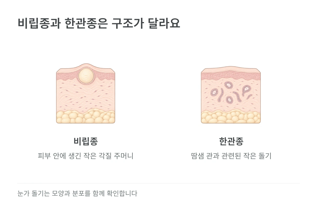 비립종과 한관종은 구조가 달라요 — 비립종·한관종