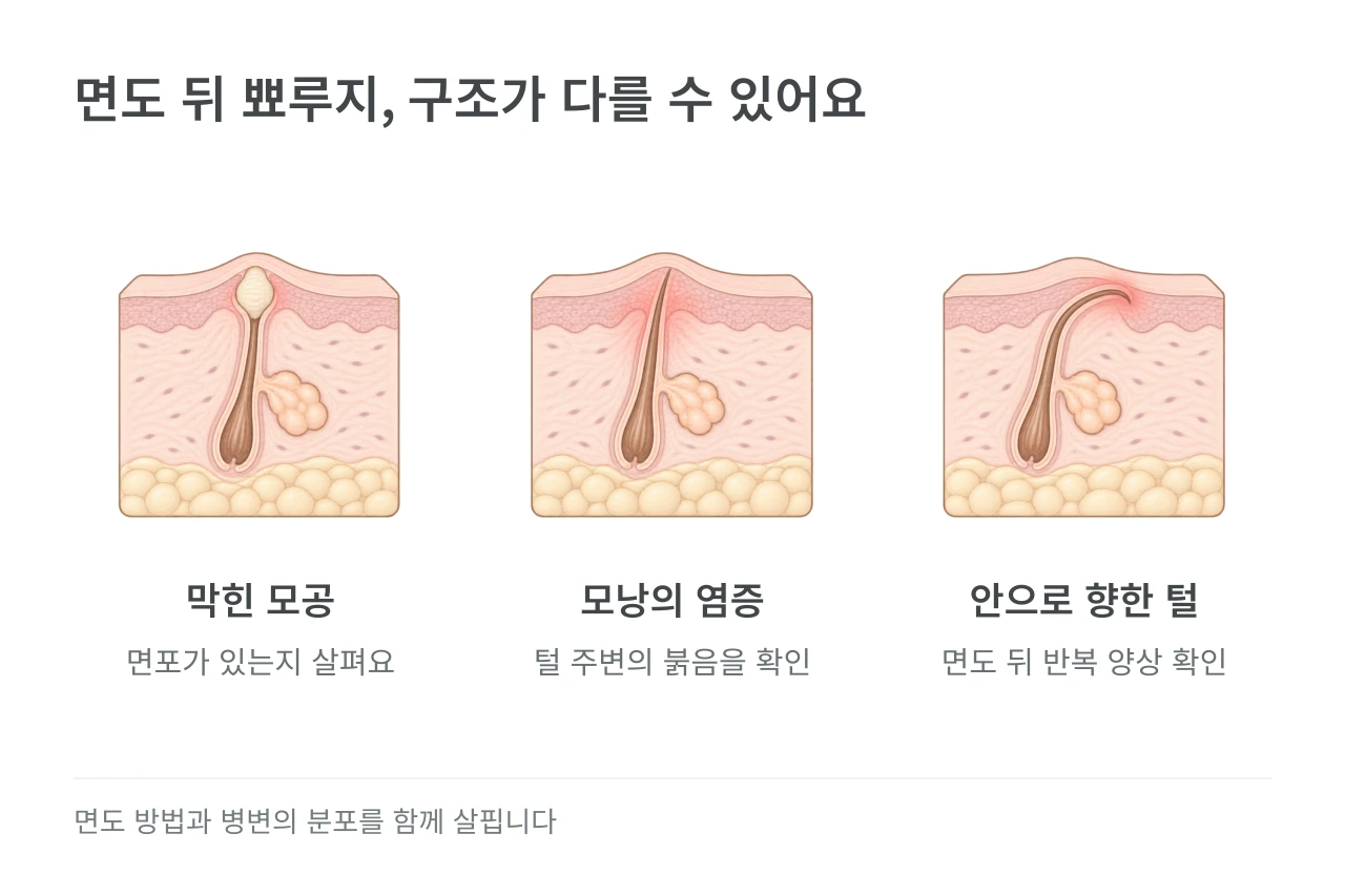 면도 뒤 뾰루지, 구조가 다를 수 있어요 — 막힌 모공·모낭의 염증·안으로 향한 털
