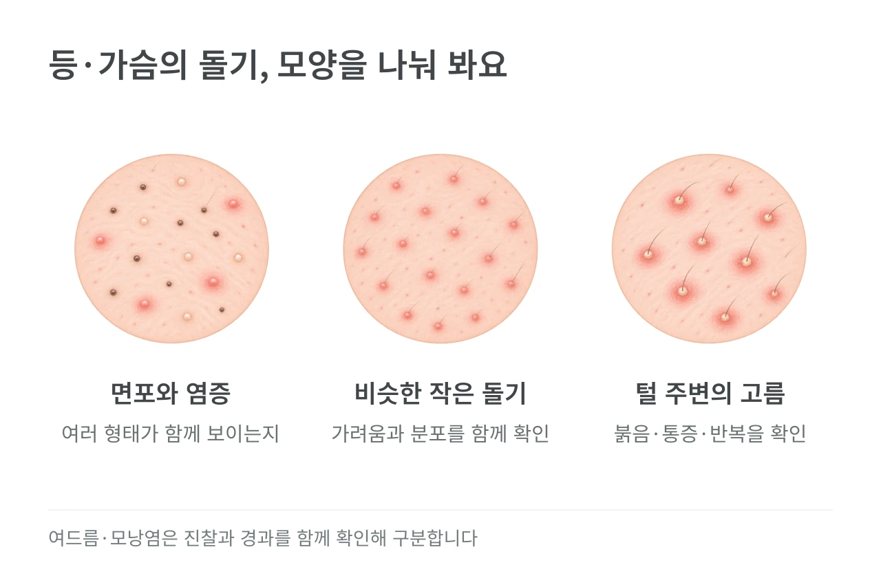 등·가슴의 돌기, 모양을 나눠 봐요 — 면포와 염증·비슷한 작은 돌기·털 주변의 고름