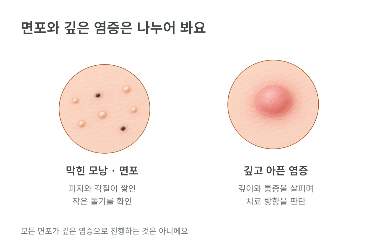 면포와 깊은 염증은 나누어 봐요 — 막힌 모낭 · 면포 피지와 각질이 쌓인 작은 돌기를 확인; 깊고 아픈 염증 깊이와 통증을 살피며 치료 방향을 판단
