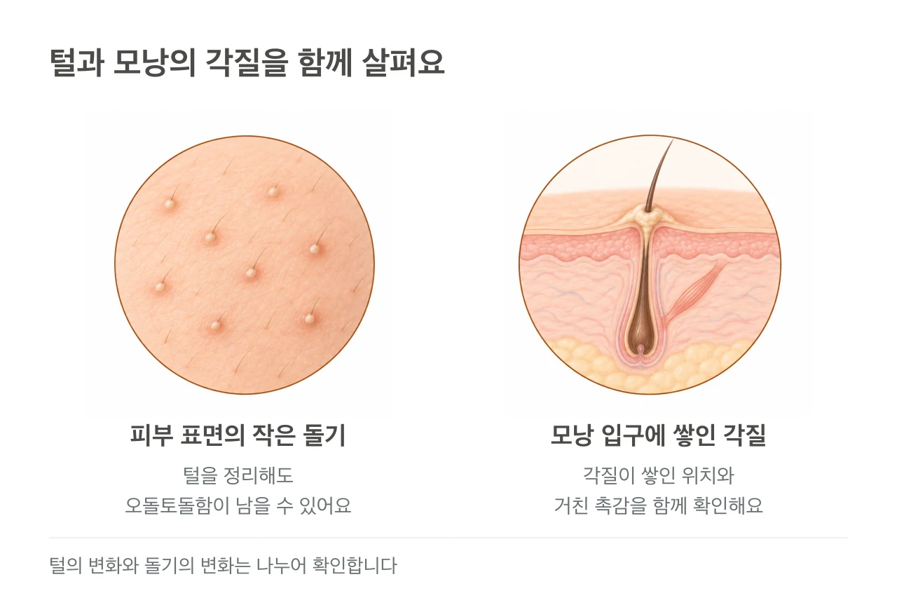 잔털과 작은 모낭성 돌기가 있는 피부 표면, 모낭 입구에 각질이 쌓인 피부 단면.