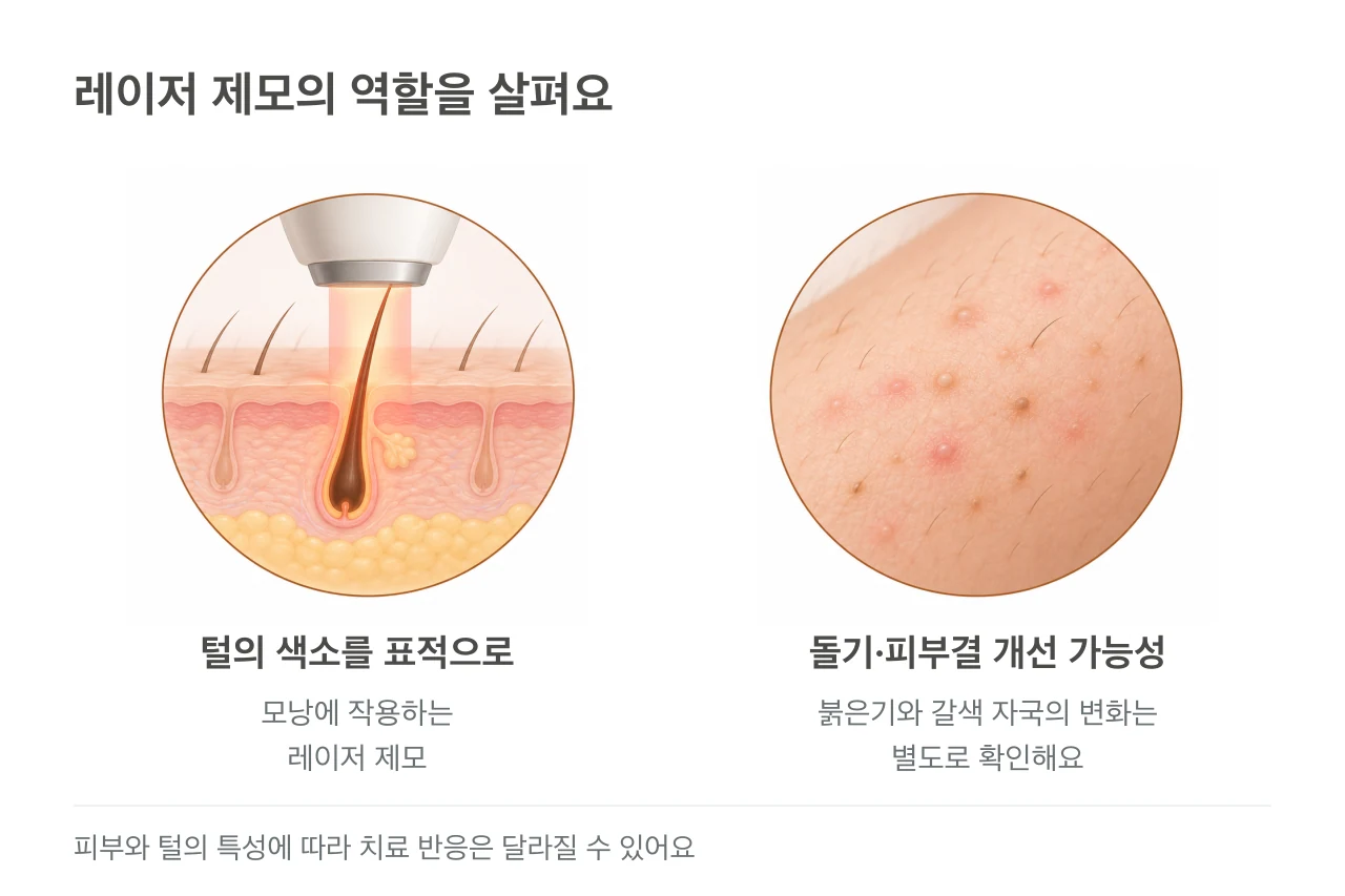 레이저가 모낭의 털에 작용하는 단면과 작은 돌기·붉은기·갈색 자국을 함께 살피는 피부 표면.
