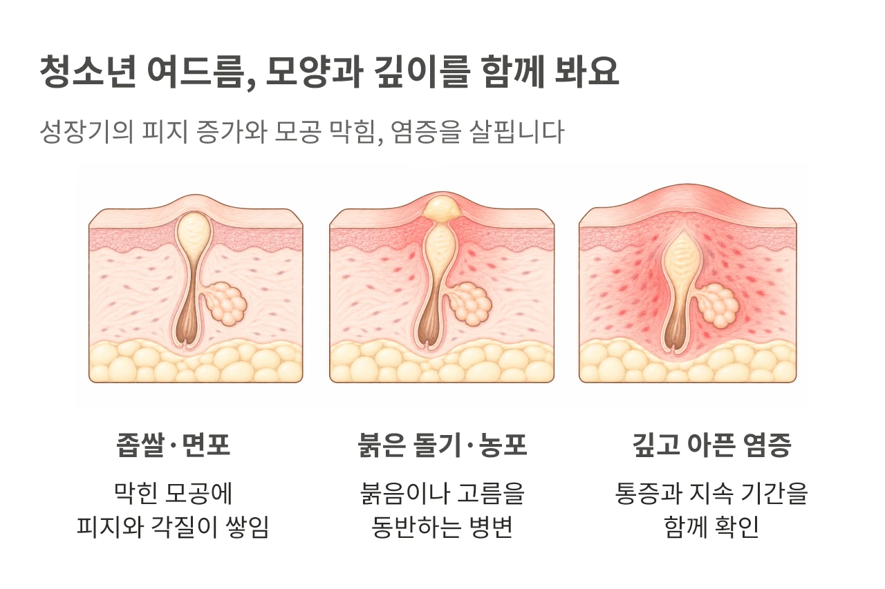 청소년 여드름, 모양과 깊이를 함께 봐요. 성장기의 피지 증가와 모공 막힘, 염증을 살핍니다